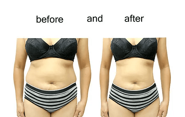 Body Contouring Results
