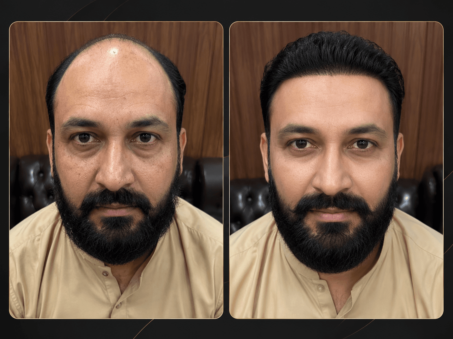Hair Transplant Results