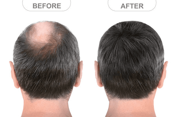 Crown Density - hair transplant result at Miami Plastic Surgery Peshawar