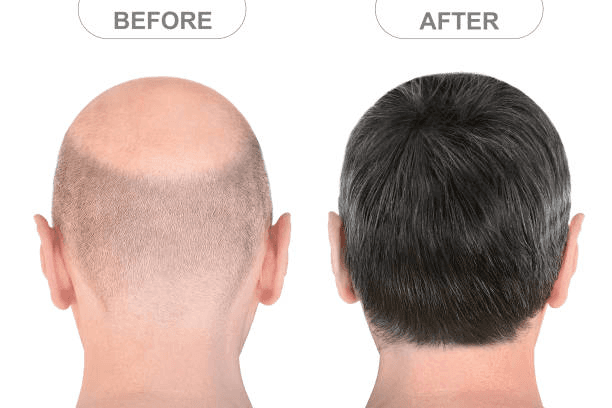 Before and after hair transplant result