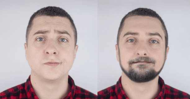 Beard & Eyebrow Restoration technique at Miami Plastic Surgery Peshawar
