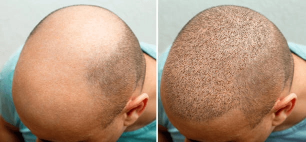 FUE Hair Transplant technique at Miami Plastic Surgery Peshawar