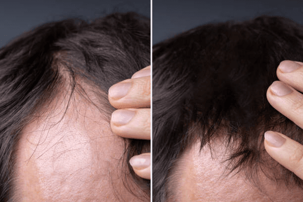 Sapphire FUE technique at Miami Plastic Surgery Peshawar