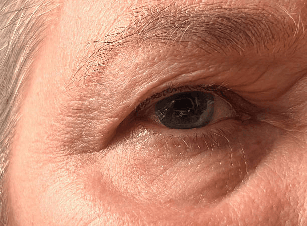 Upper eyelid heaviness and skin laxity closeup