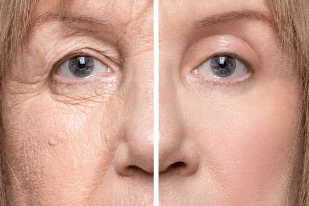 Mature eyelid rejuvenation comparison reference