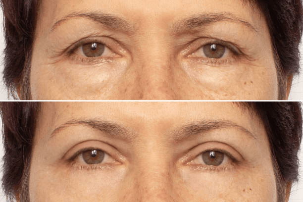 Rested upper eyelid appearance comparison reference