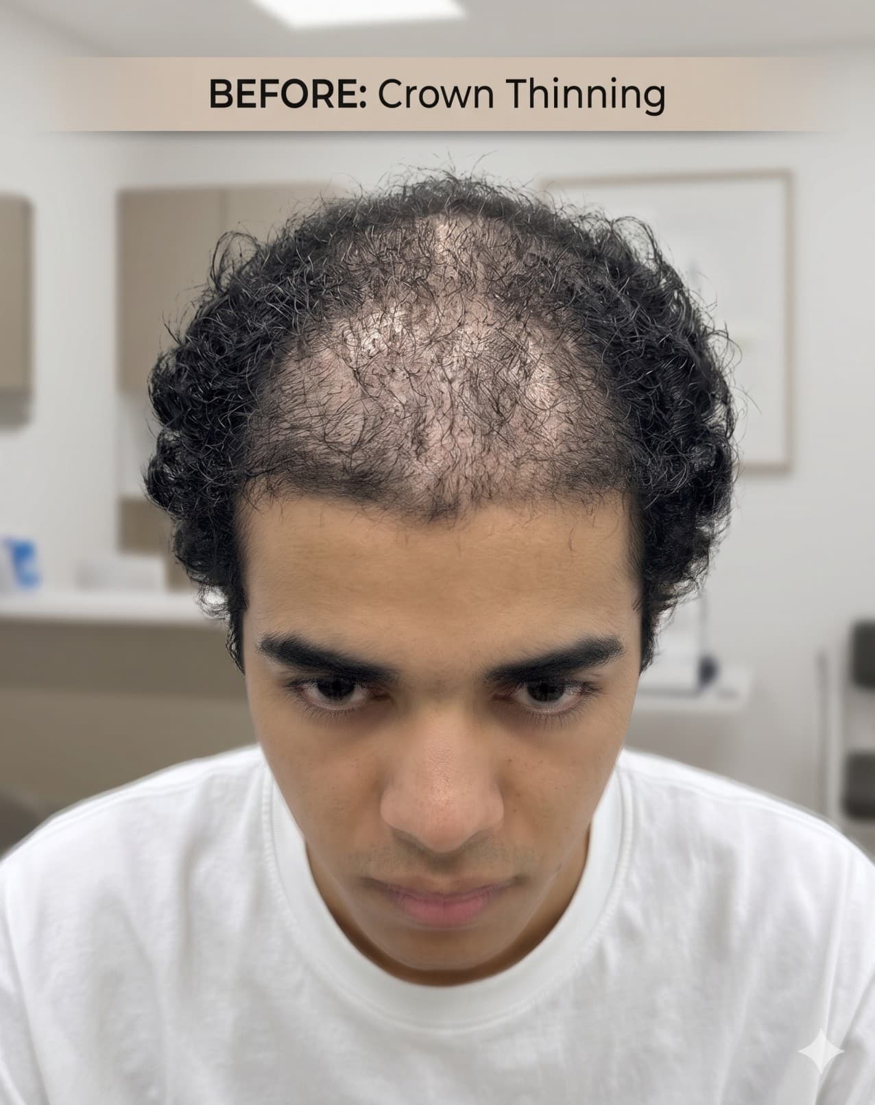 Crown thinning assessment before hair restoration planning