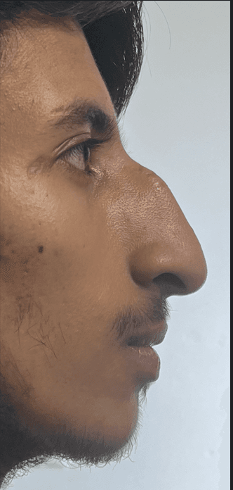 Profile balance rhinoplasty after — Cosmetic Nose Surgery Peshawar