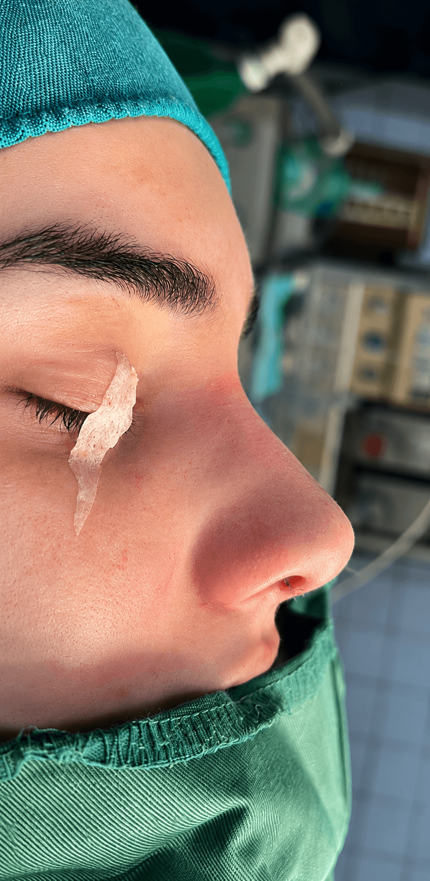 Profile balance rhinoplasty before — Nose Surgery Peshawar