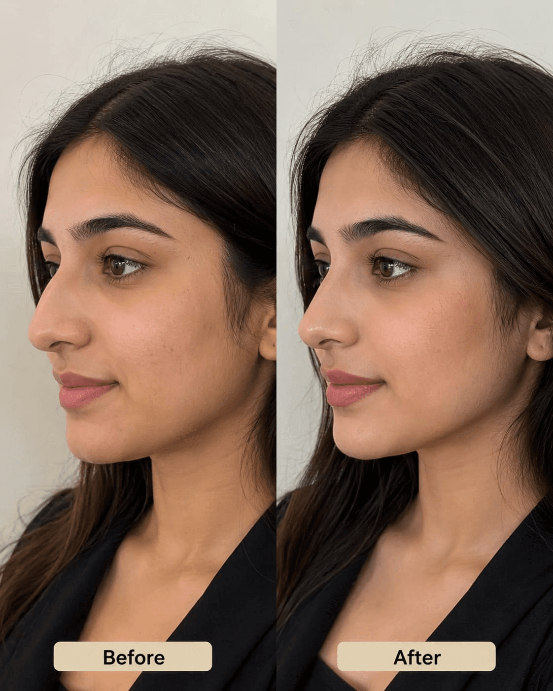 Rhinoplasty before — Miami Plastic Surgery Peshawar