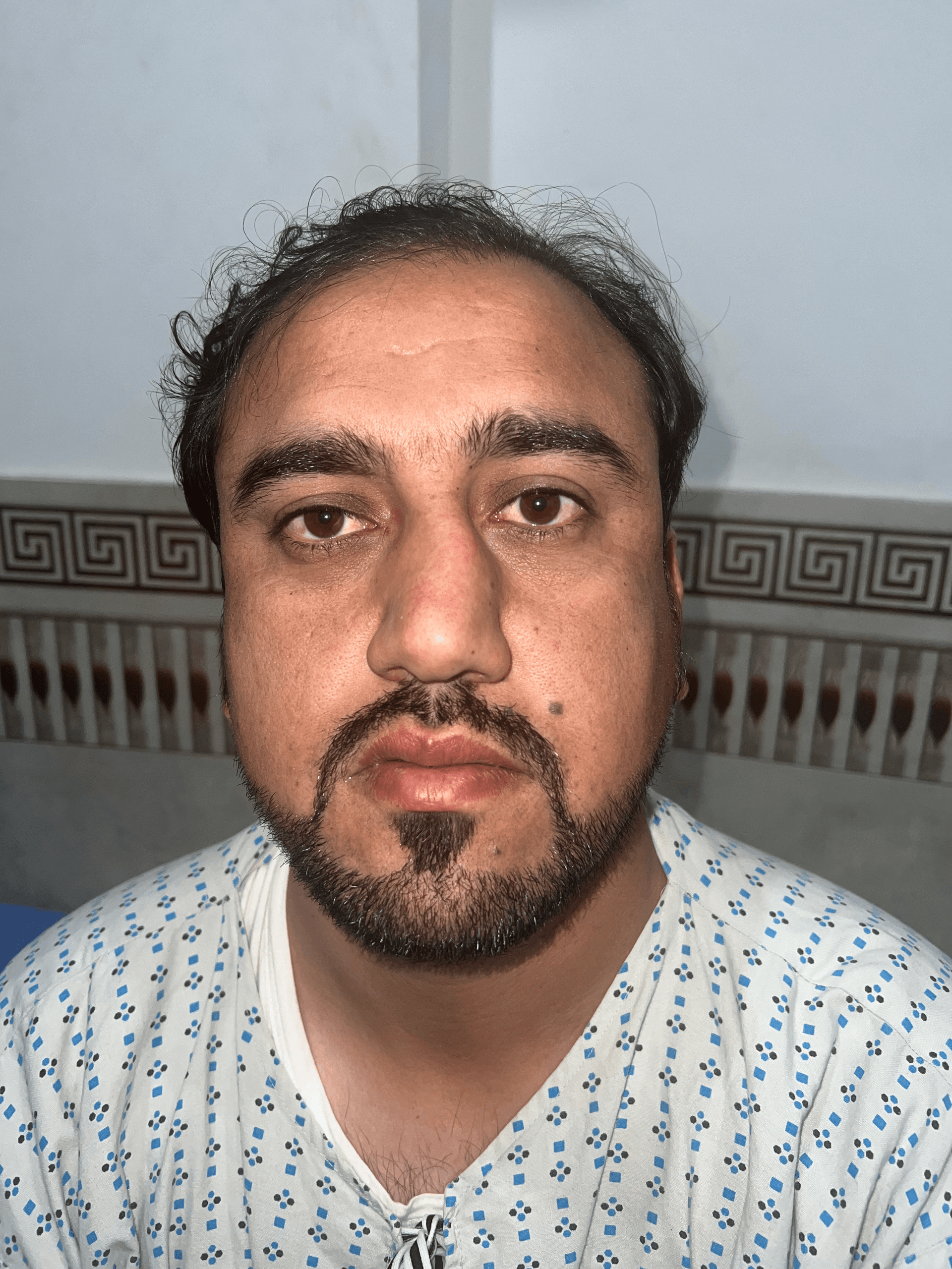 Scar revision before — reconstructive surgery Peshawar