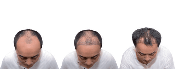 DHI Hair Transplant technique at Miami Plastic Surgery Peshawar