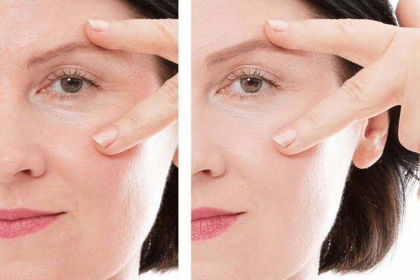 Close brow lift comparison reference