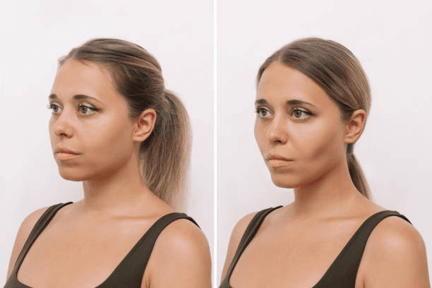 Brow lift profile comparison reference