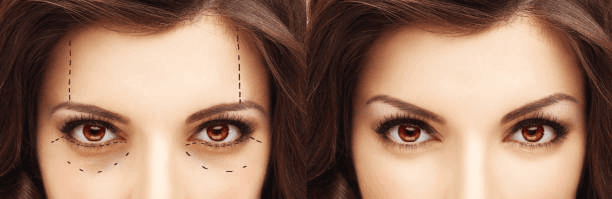 Forehead Lift in Peshawar upper face analysis