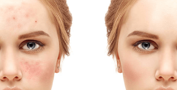 Laser skin rejuvenation before and after