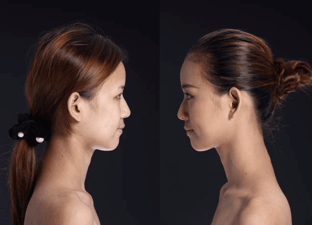 Dark profile chin augmentation comparison reference