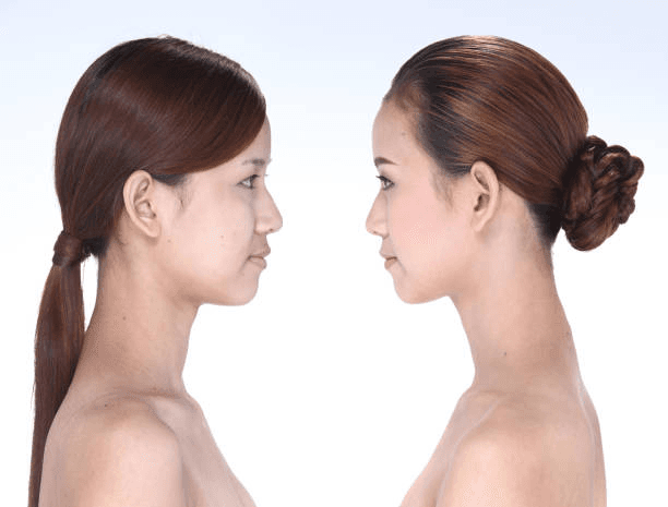 Chin Augmentation in Peshawar profile balancing