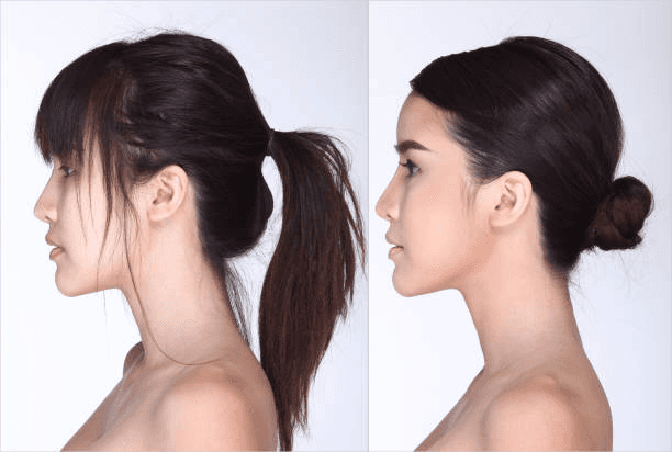 Chin Augmentation in Peshawar profile balancing