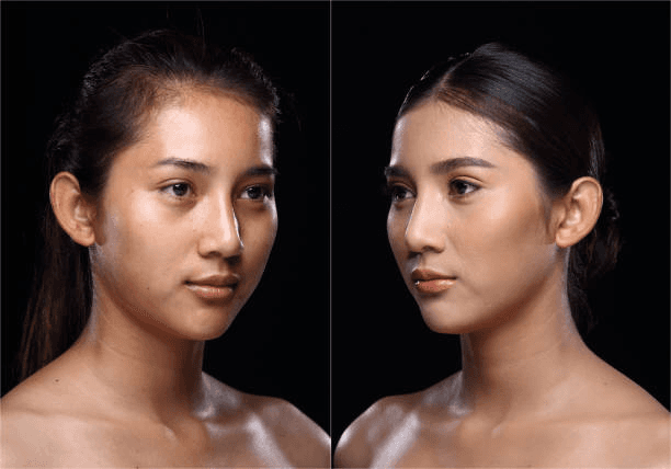 Chin augmentation consultation visual at Miami Plastic Surgery and Hair Transplant Center