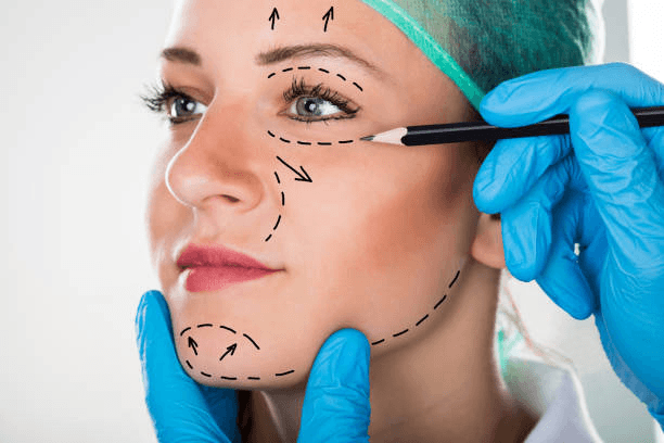 Full face Deep Plane Facelift before and after โ natural midface lift result