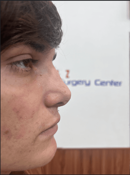 Bridge Irregularity after revision rhinoplasty Peshawar