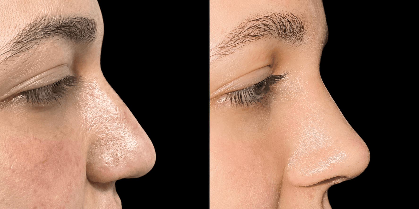 Revision rhinoplasty profile planning visual