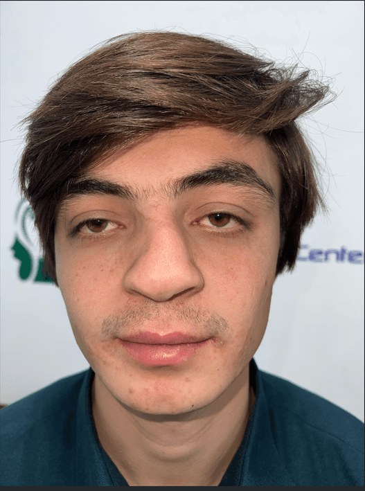 Overall Proportion before revision rhinoplasty Peshawar