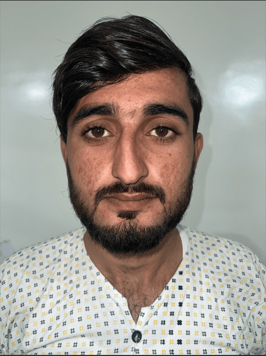 Tip Asymmetry before revision rhinoplasty Peshawar