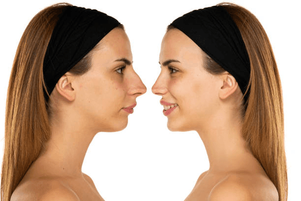 Bridge refinement rhinoplasty result — Nose Surgery Peshawar