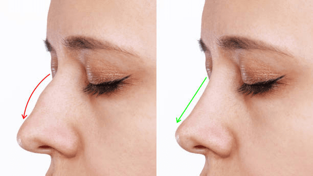 Tip refinement rhinoplasty result — Nose Surgery Peshawar