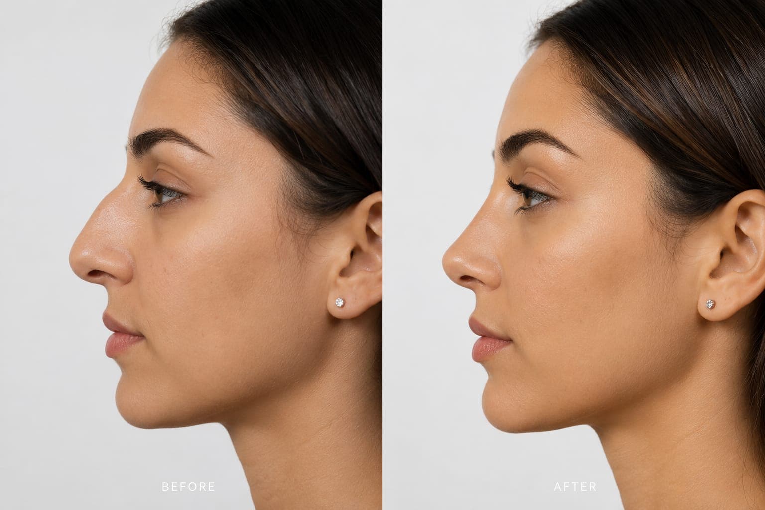 Jawline and profile before and after result