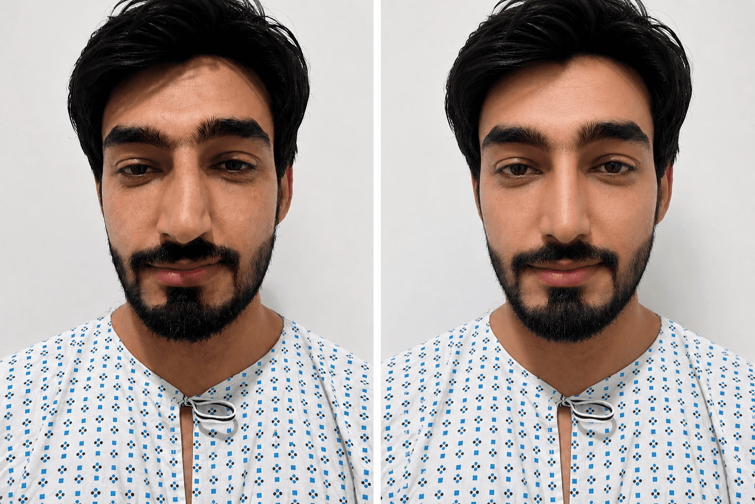 Male rhinoplasty before and after front view