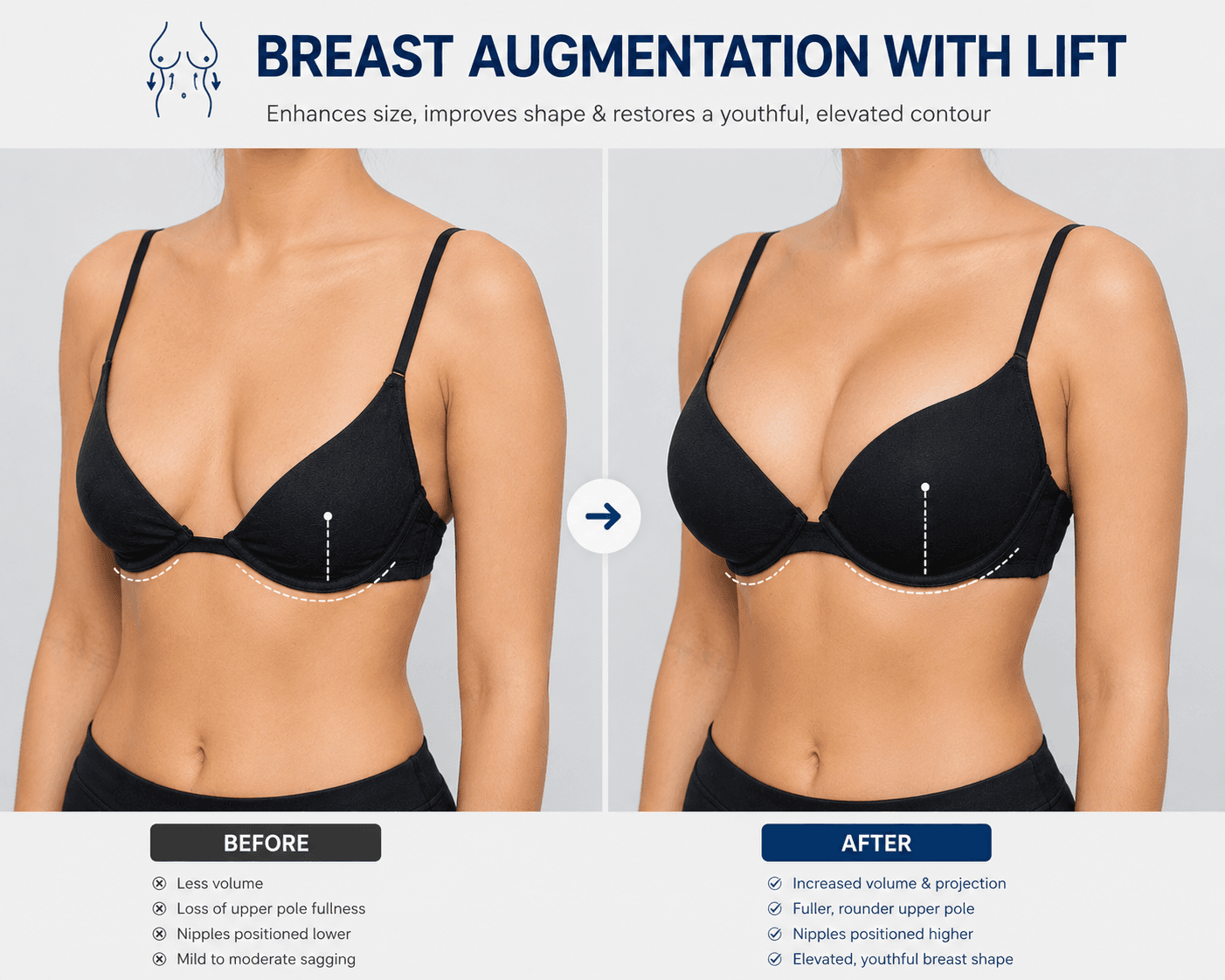Breast Aug with Lift – breast surgery Miami clinic Peshawar