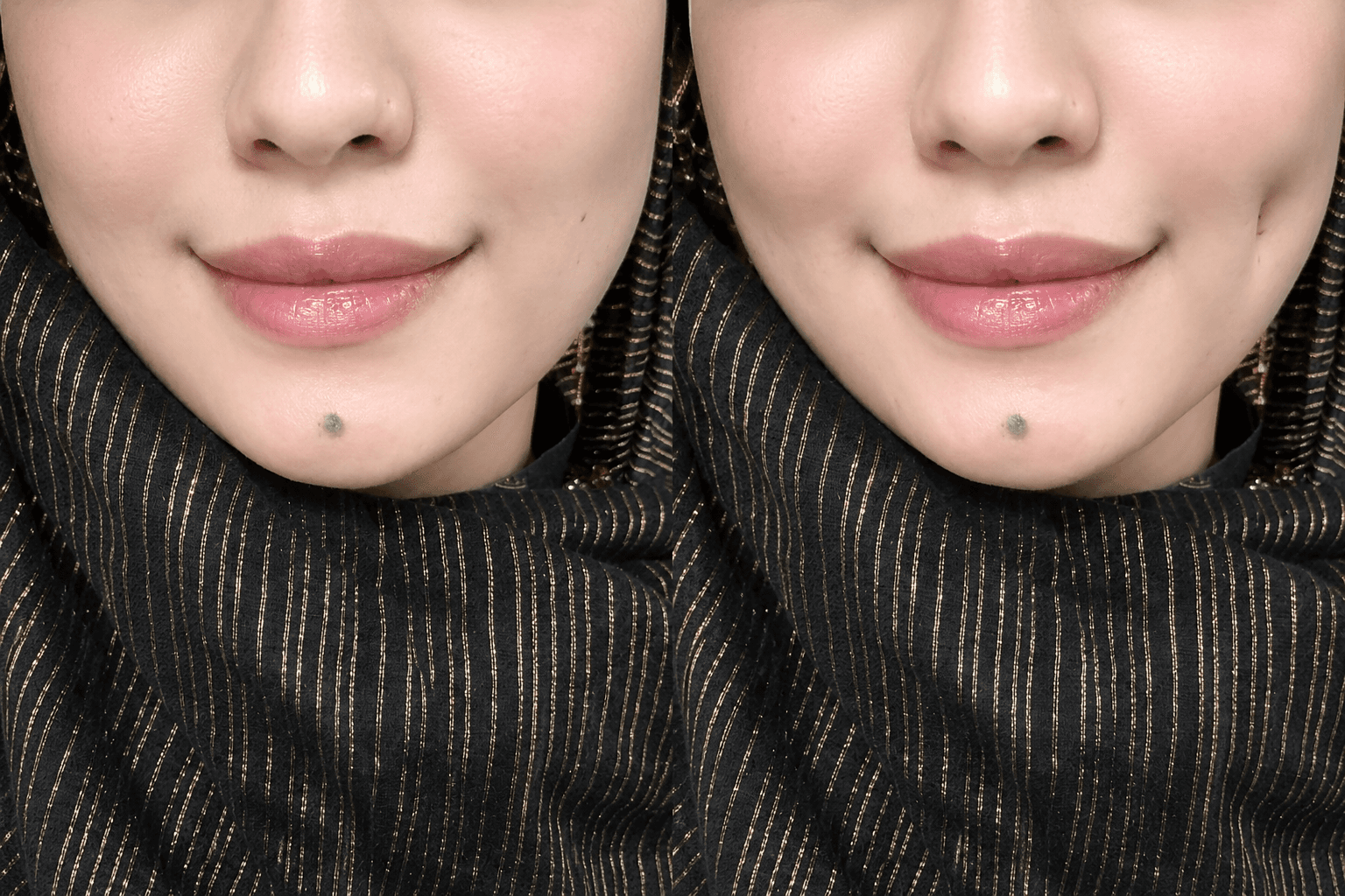 Facial contouring sculpting – Miami clinic Peshawar