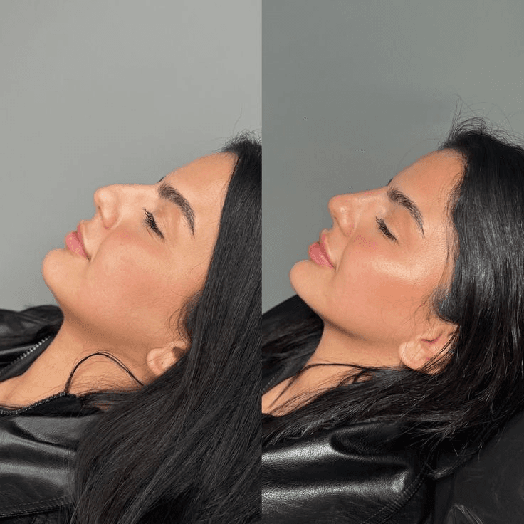 Facial Harmony before
