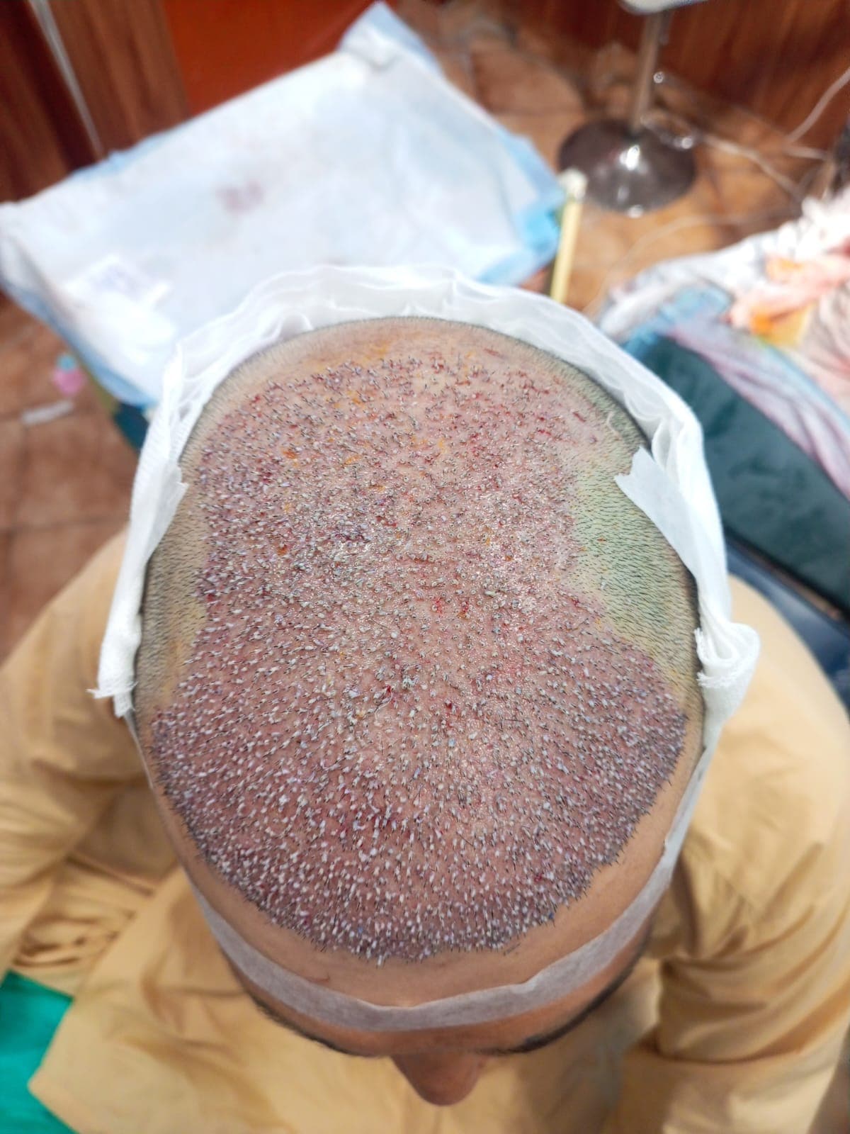 Hair Restoration after