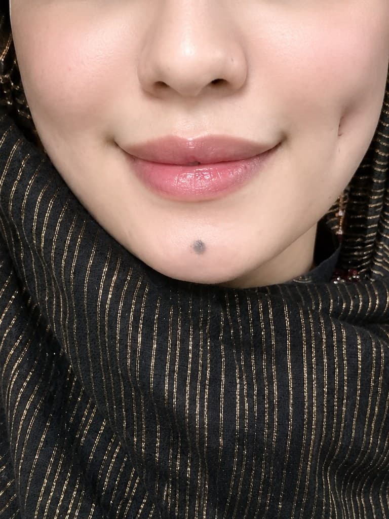 Dimpleplasty after visible cheek dimples