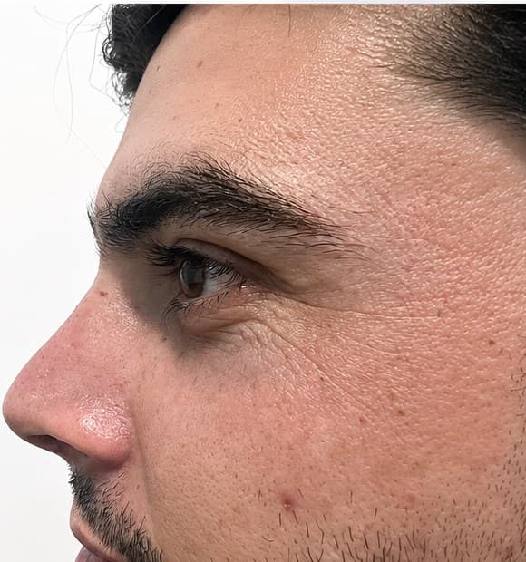 Rhinoplasty after profile view with refined nasal contour