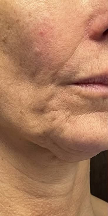 Skin tightening before lower face treatment