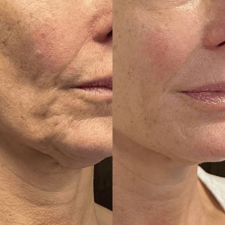 Skin tightening treatment – Miami clinic Peshawar